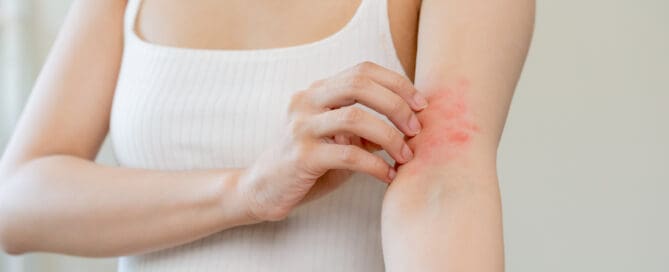 Woman wearing white tank top is scratching her arm in red area