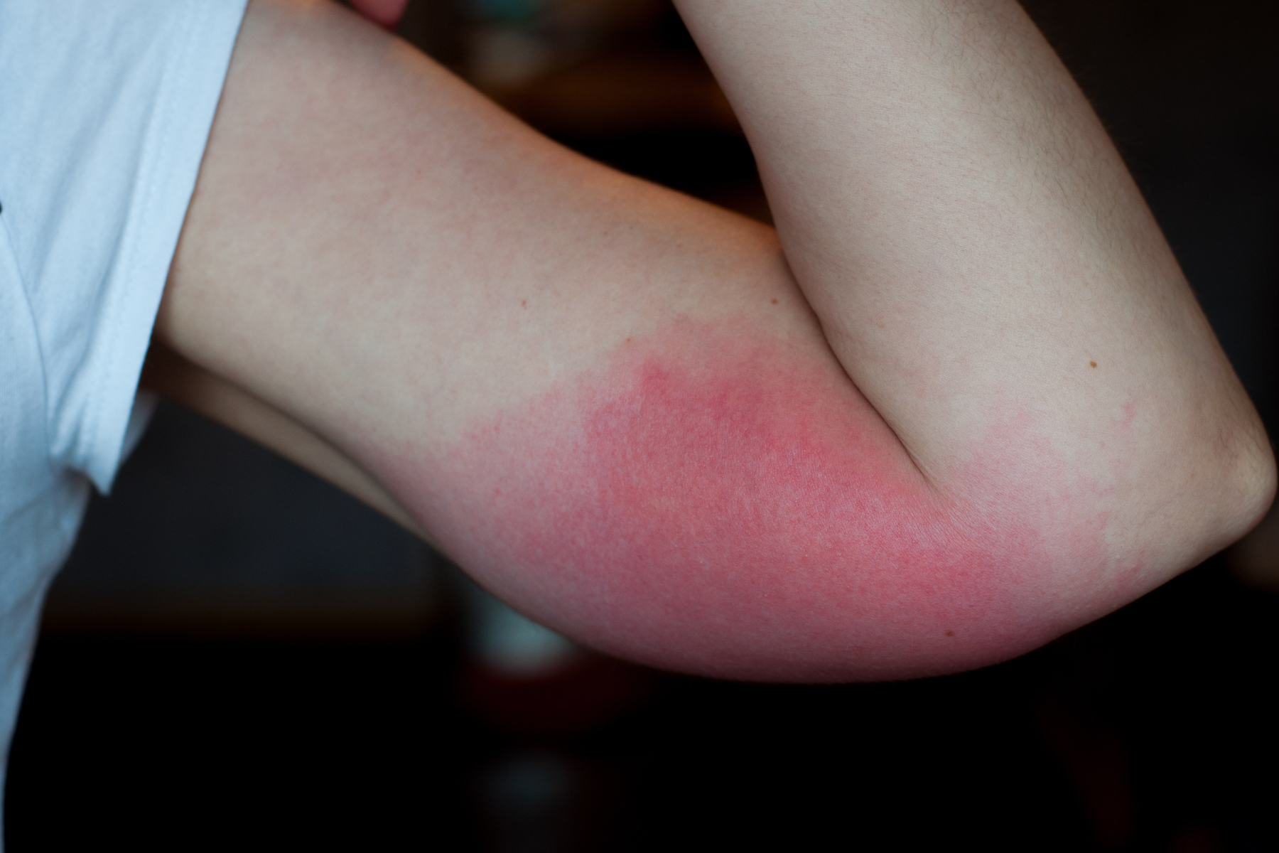 Close-up of an arm with a noticeable sunburn, showing redness and irritation.