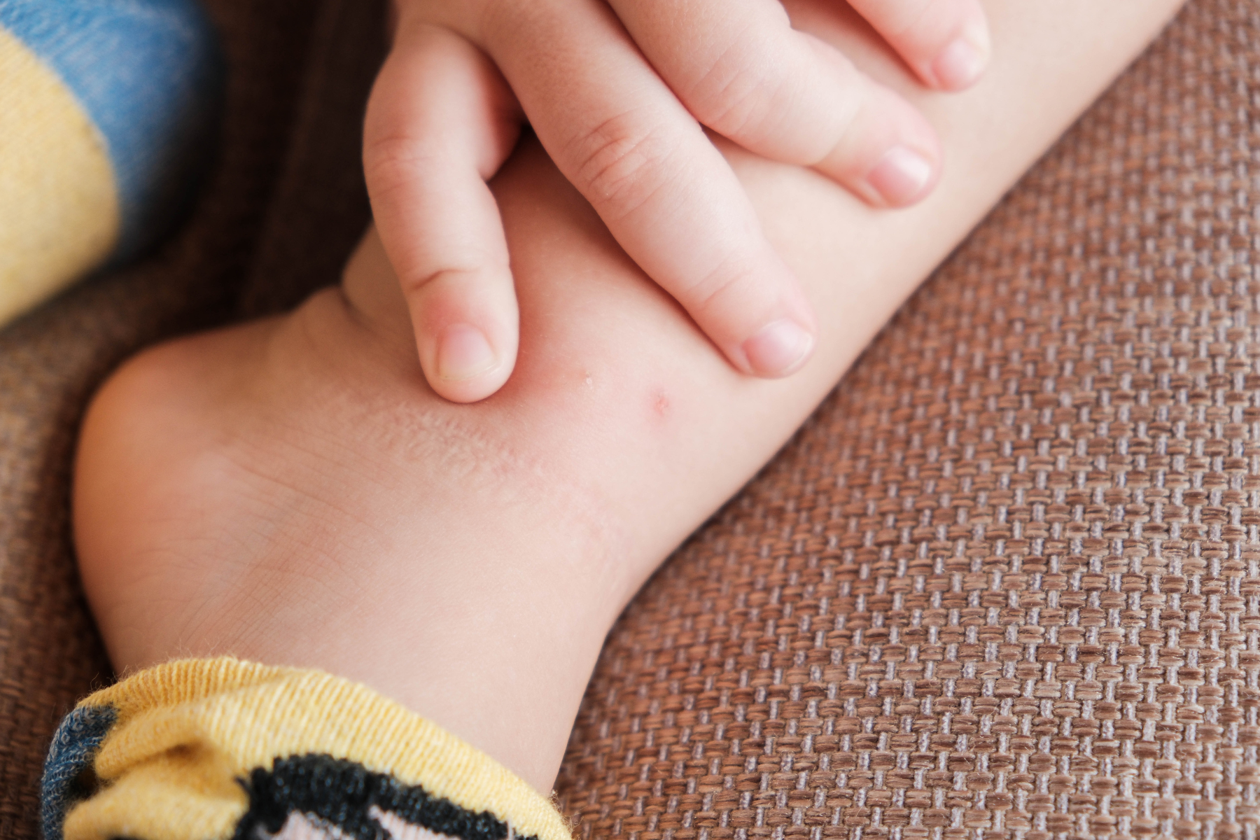Red bite marks on a child's ankle being examined by their fingers, illustrating common signs of bed bug bites on sensitive skin.