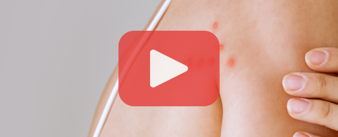 Irritated red bumps in a linear pattern across a person’s back and shoulder, indicating a typical bed bug bite trail, with Prevent Pest Control branding and video overlay.