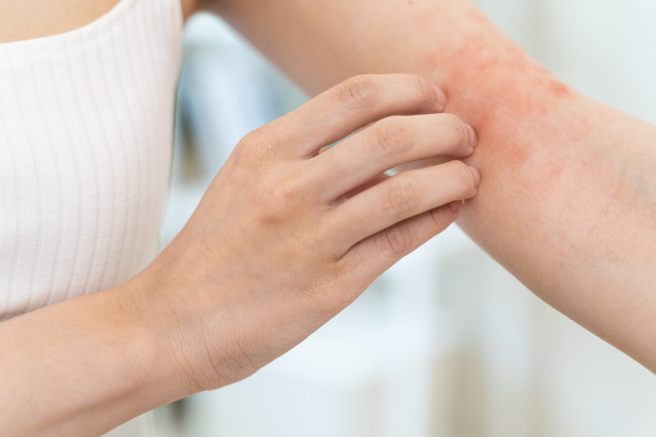 Woman itching on her arm.