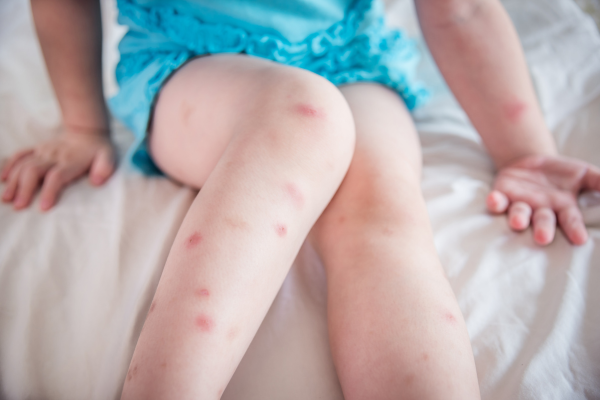 A child with legs full of bed bug bites.
